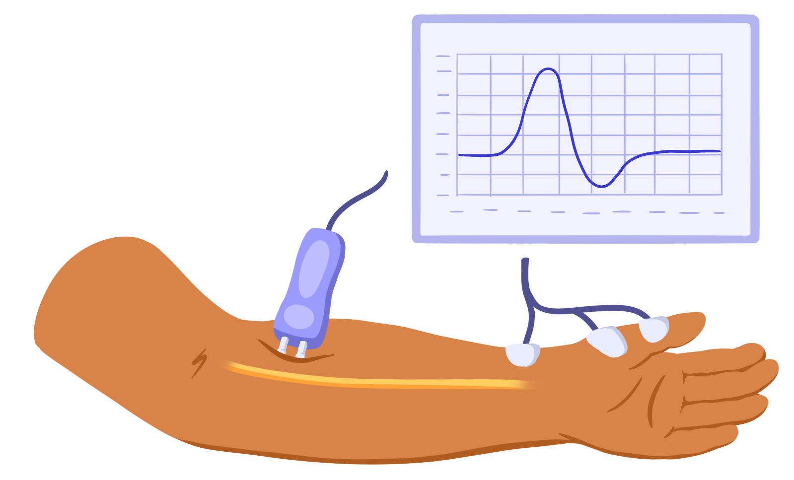A nerve stimulator is placed on the skin of an arm. Electrical signals from the nerve can be seen on the graph nearby.